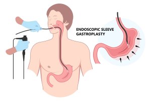 Endoscopische maagverkleining
